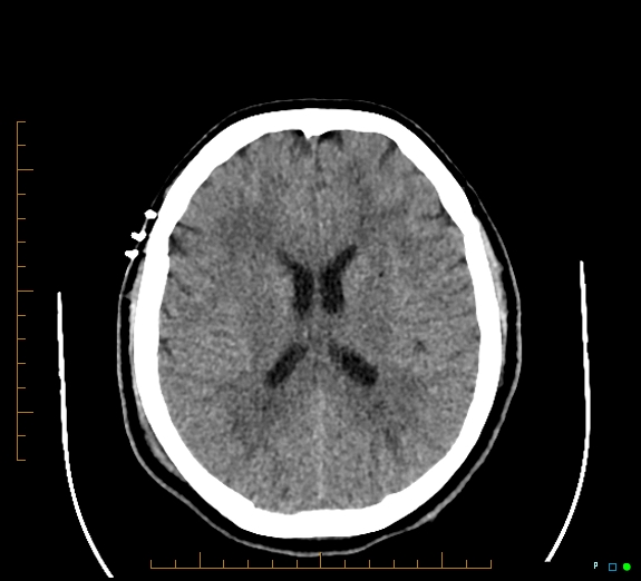 File:Cerebral fat embolism (Radiopaedia 85521-101220 Axial non-contrast 38).jpg