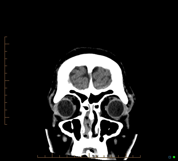 Cerebral fat embolism (Radiopaedia 85521-101224 Coronal non-contrast 9).jpg