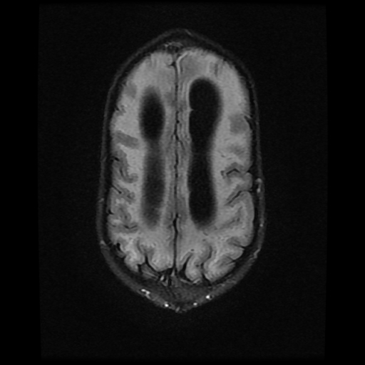 File:Cerebral manifestations of mucopolysaccharidosis type I (Radiopaedia 59171-66487 Axial FLAIR 17).jpg
