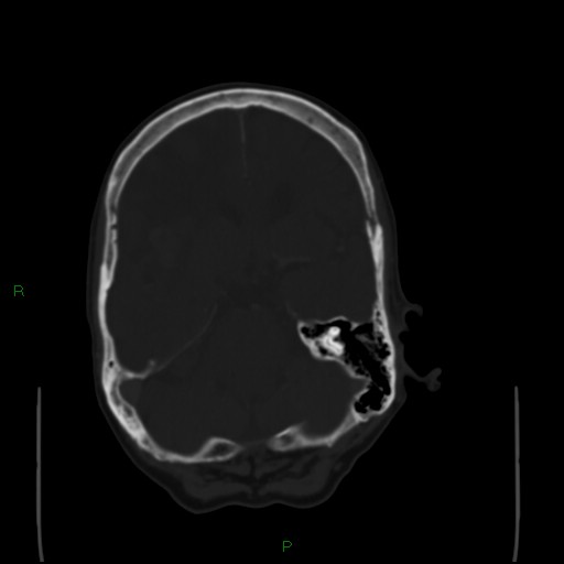 Cerebral metastases - breast primary (Radiopaedia 77653-89857 Axial bone window 41).jpg