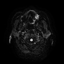 Cerebral metastases - melanoma (Radiopaedia 80972-94522 Axial DWI 2).jpg