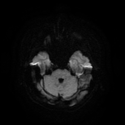 Cerebral metastases - melanoma (Radiopaedia 80972-94522 Axial DWI 42).jpg
