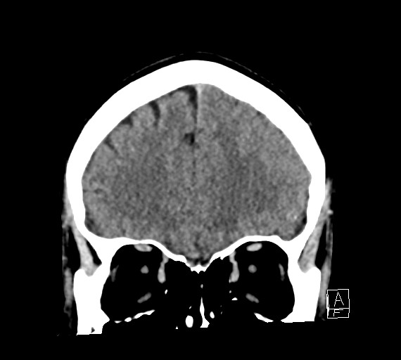 Cerebral metastases - testicular choriocarcinoma (Radiopaedia 84486-99855 Coronal C+ delayed 16).jpg