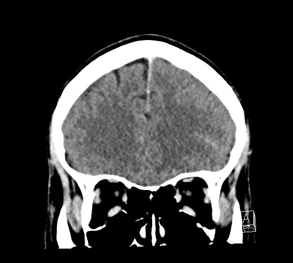 Cerebral metastases - testicular choriocarcinoma (Radiopaedia 84486-99855 D 17).jpg