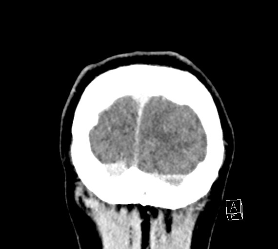 Cerebral metastases - testicular choriocarcinoma (Radiopaedia 84486-99855 D 58).jpg