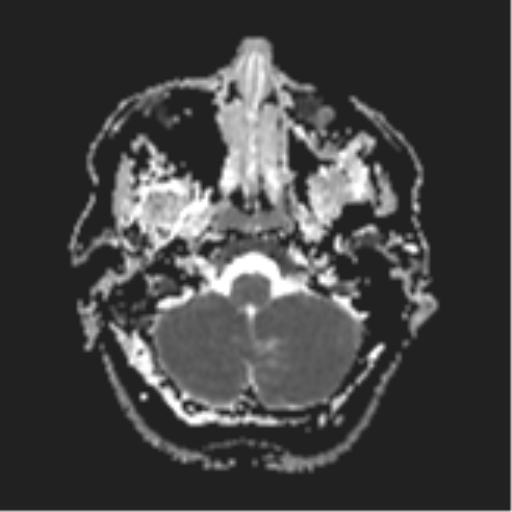 File:Cerebral metastases mimicking abscesses (Radiopaedia 45841-50131 Axial ADC 6).png