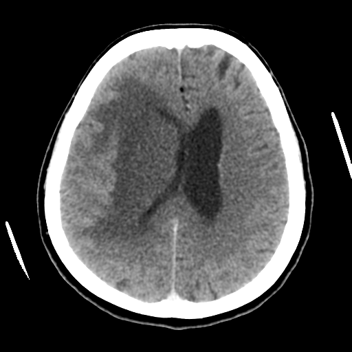 Cerebral metastasis to basal ganglia (Radiopaedia 81568-95412 Axial C+ delayed 38).png