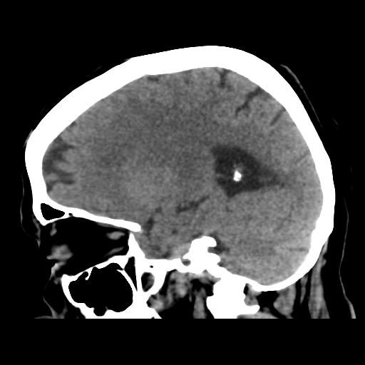 Cerebral metastasis to basal ganglia (Radiopaedia 81568-95412 E 40).png