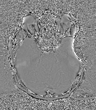 Cerebral metastasis to basal ganglia (Radiopaedia 81568-95413 Axial SWI phase 27).png