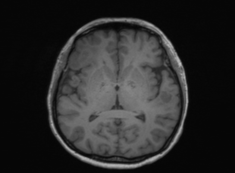 Cerebral ring enhancing lesions - cerebral metastases (Radiopaedia 44922-48817 Axial T1 226).jpg