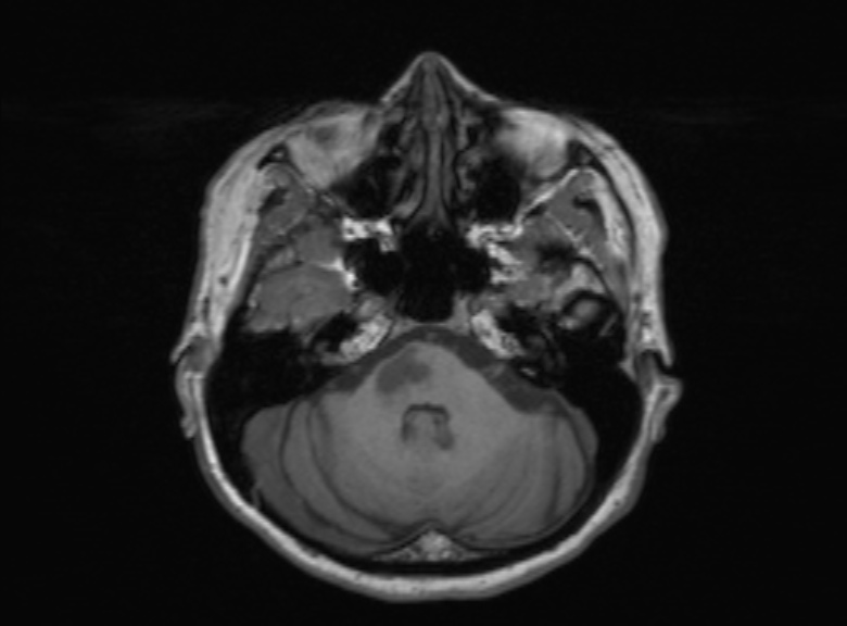 Cerebral ring enhancing lesions - cerebral metastases (Radiopaedia 44922-48817 Axial T1 300).jpg