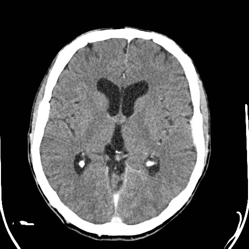 File:Cerebral toxoplasmosis (Radiopaedia 43956-47460 Axial C+ delayed 18).jpg