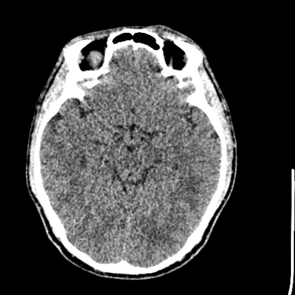 Cerebral toxoplasmosis (Radiopaedia 53993-60131 Axial non-contrast 34).jpg