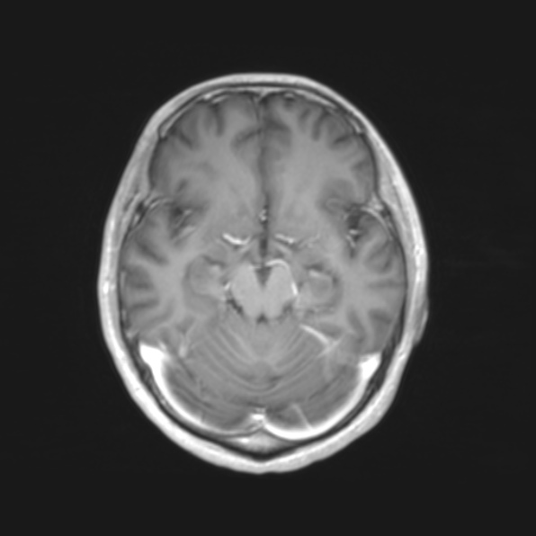File:Cerebral toxoplasmosis (Radiopaedia 53993-61435 Axial T1 8).jpg