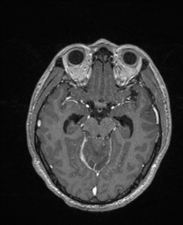 Cerebral toxoplasmosis (Radiopaedia 85779-101597 Axial T1 C+ 66).jpg