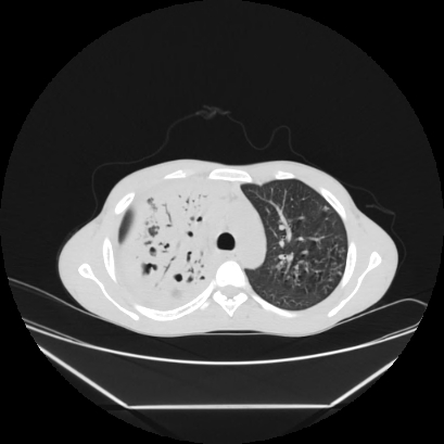 Cerebral tuberculoma (Radiopaedia 80829-94318 Axial lung window 53).jpg