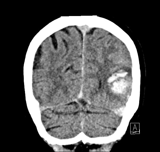 Cerebral venous infarction with hemorrhage (Radiopaedia 65343-74381 Coronal non-contrast 46).jpg