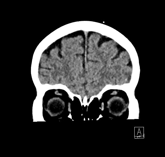 Cerebral venous infarction with hemorrhage (Radiopaedia 65343-74381 Coronal non-contrast 8).jpg