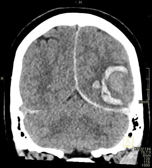 Cerebral venous sinus thrombosis (Radiopaedia 91329-108965 Coronal non-contrast 44).jpg