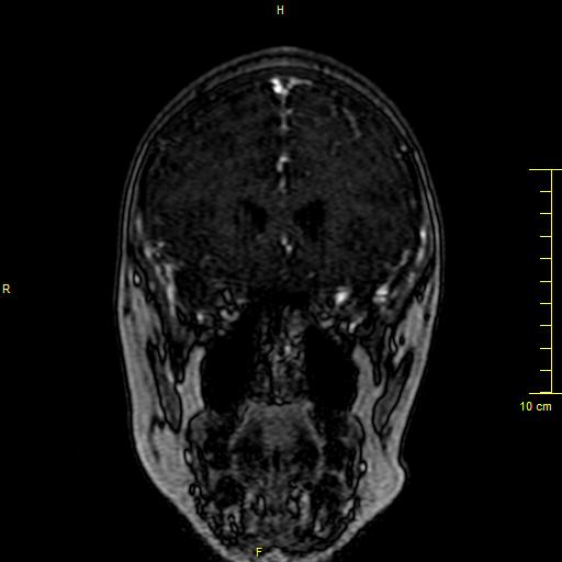 Cerebral venous thrombosis (Radiopaedia 23288-23351 MRV 27).JPG
