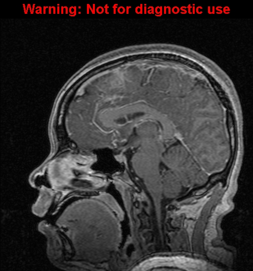 File:Cerebral venous thrombosis (Radiopaedia 37224-39208 Sagittal T1 C+ 75).jpg