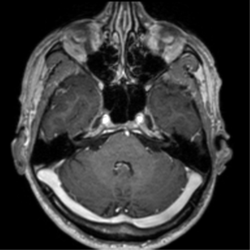 Cerebral venous thrombosis (Radiopaedia 38392-40469 Axial T1 C+ 23).png