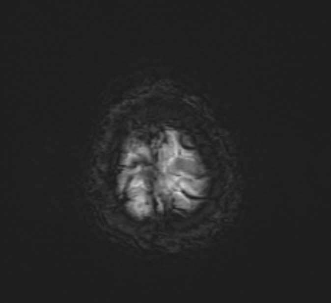 Cerebral venous thrombosis (Radiopaedia 71207-81504 Axial SWI 52).jpg