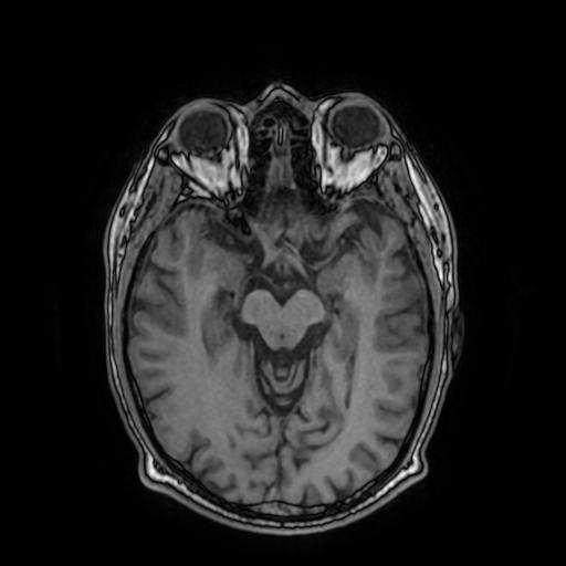 Cerebral venous thrombosis with secondary intracranial hypertension (Radiopaedia 89842-106957 Axial T1 82).jpg