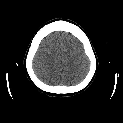File:Cerebral venous thrombosis with venous hemorrhagic infarct (Radiopaedia 90354-107660 Axial non-contrast 40).jpg