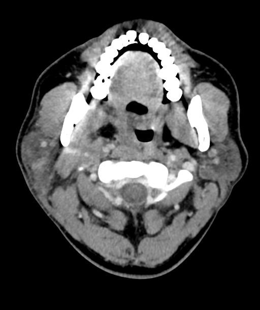 Cervical abscess (Radiopaedia 43725-47184 A 18).png