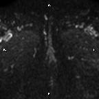 Cervical adenocarcinoma (Radiopaedia 65011-73985 Axial DWI 1).jpg