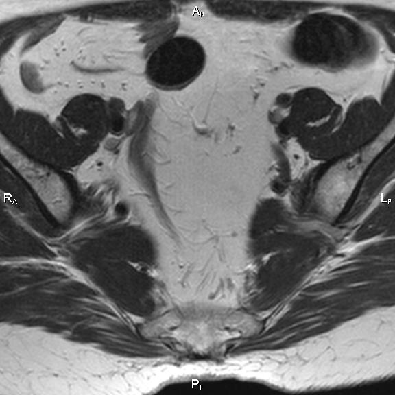 File:Cervical adenocarcinoma (Radiopaedia 65011-73985 Axial T2 30).jpg