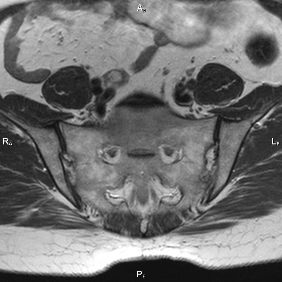 File:Cervical adenocarcinoma (Radiopaedia 65011-73985 Axial T2 36).jpg