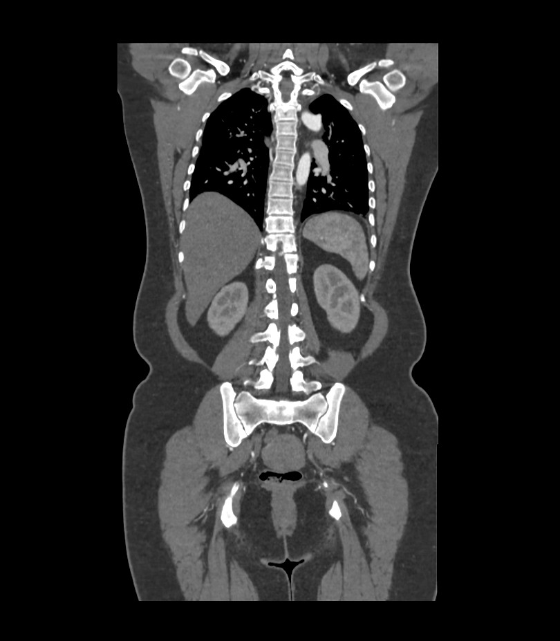 Cervical aortic arch with coarctation and aneurysms (Radiopaedia 44035-47552 C 13).jpg