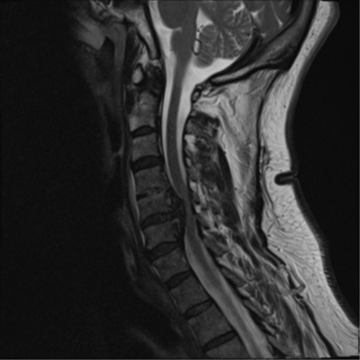File:Cervical canal stenosis due to ossification of the posterior longitudinal ligament (Radiopaedia 47260-51824 Sagittal T2 9).png