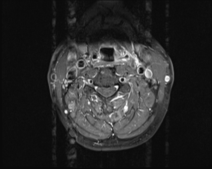 File:Cervical disc extrusion (Radiopaedia 53950-60077 Axial T1 C+ fat sat 9).jpg