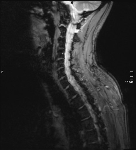 File:Cervical dural CSF leak on MRI and CT treated by blood patch (Radiopaedia 49748-54995 D 3).png