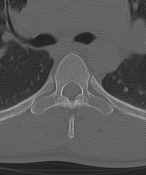 Cervical intercalary bone (Radiopaedia 35211-36748 Axial bone window 88).png