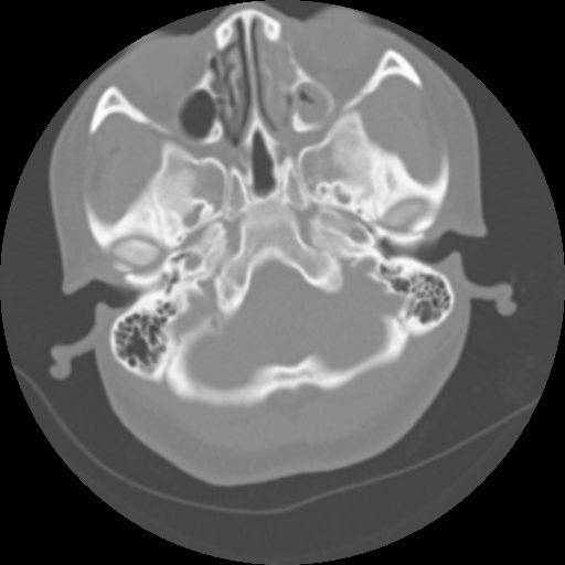 Cervical rib (Radiopaedia 71110-81363 Axial non-contrast 10).jpg