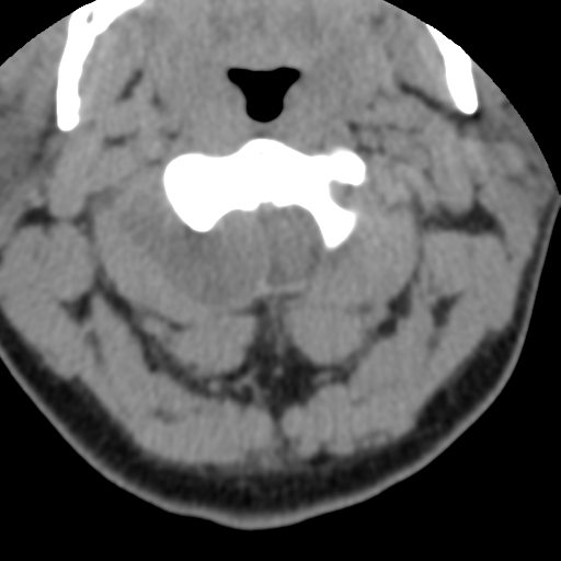Cervical schwannoma (Radiopaedia 57979-64974 Axial non-contrast 19).png