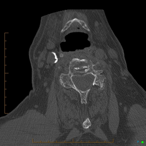 File:Cervical spine fracture - ankylosing spondylitis (Radiopaedia 76835-88706 Axial bone window 125).jpg