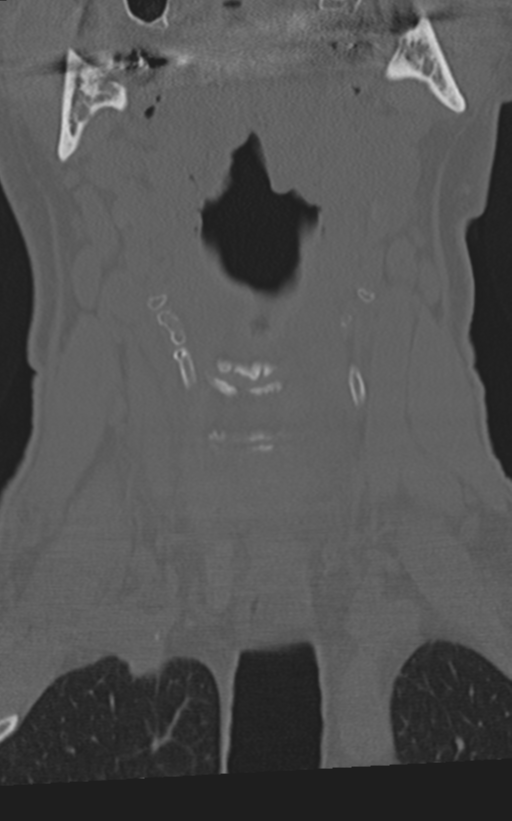 Cervical spine fractures with vertebral artery dissection (Radiopaedia 53296-59268 Coronal bone window 15).png