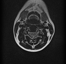 File:Cervical spondylodiscitis and calvarial hemangioma (Radiopaedia 64317-73104 Axial T2 5).jpg