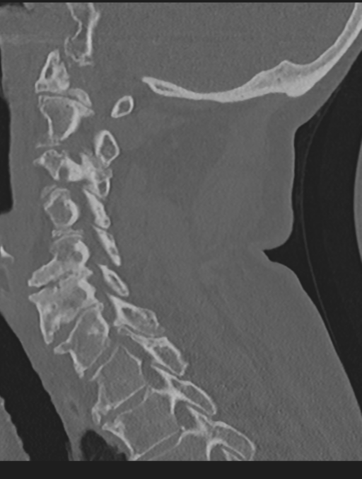 Cervical spondylolysis (Radiopaedia 49616-54811 Sagittal bone window 44).png