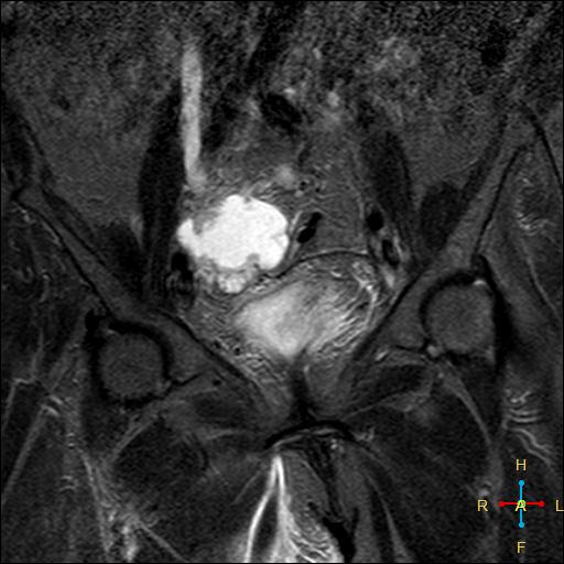 File:Cervical stump squamous cell carcinoma (Radiopaedia 48049-52858 G 3).jpg