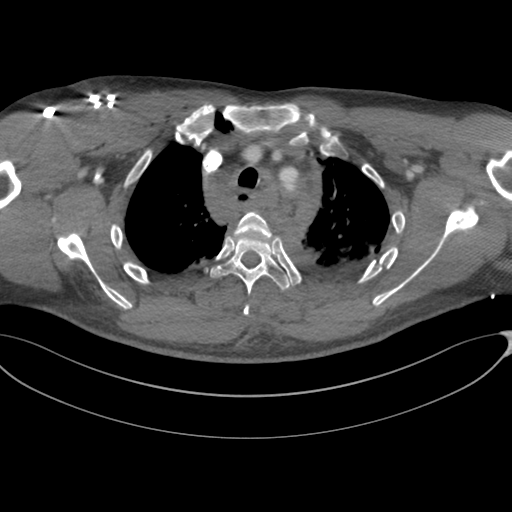 File:Chest multitrauma - aortic injury (Radiopaedia 34708-36147 A 67).png