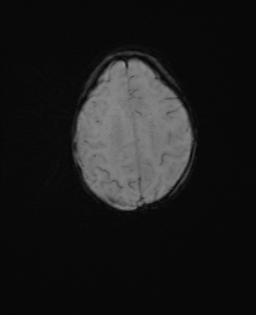 Chiari III malformation with occipital encephalocele (Radiopaedia 79446-92559 Axial SWI 49).jpg