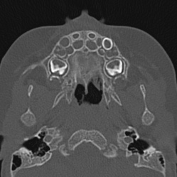 Choanal atresia (Radiopaedia 88525-105975 Axial bone window 14).jpg