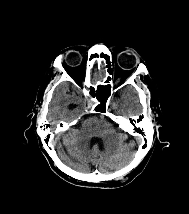 Cholangiocarcinoma with cerebral metastases (Radiopaedia 83519-98628 Axial non-contrast 23).jpg