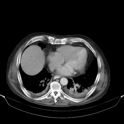 File:Cholangitis and abscess formation in a patient with cholangiocarcinoma (Radiopaedia 21194-21100 A 6).jpg